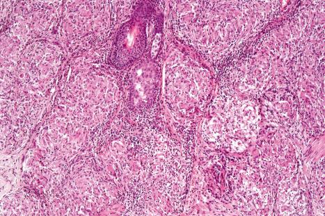 Fig. 9.18, Sarcoidosis: note the paucity of lymphocytes and absence of necrosis.