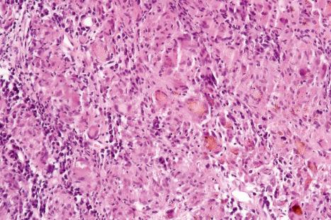 Fig. 9.20, Sarcoidosis: in this example, the granulomatous reaction is associated with abundant foreign material.