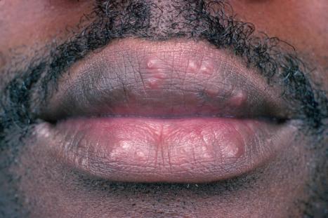 Fig. 9.2, Sarcoidosis: papules are present on both upper and lower lips.