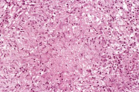 Fig. 9.21, Sarcoidosis: occasionally small foci of ‘fibrinoid’ necrosis may be seen in the center of the granuloma, but cellular detail is not lost.