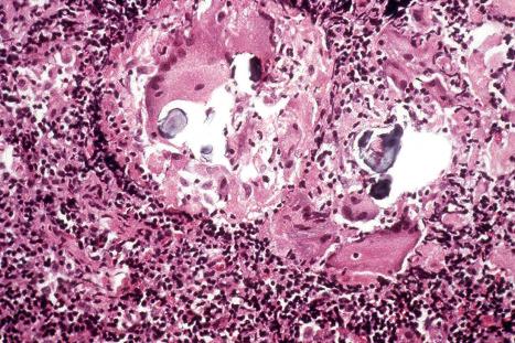 Fig. 9.22, Sarcoidosis: in this lymph node biopsy specimen, fragmented, laminated Schaumann bodies are seen. They are very rarely a feature of cutaneous sarcoidosis.