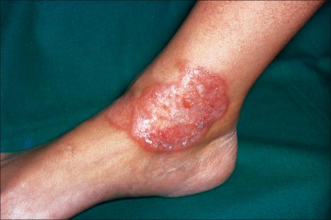 Fig. 9.27, Localized granuloma annulare: in this patient, there is a large plaque on the ankle with a hint of central clearing.