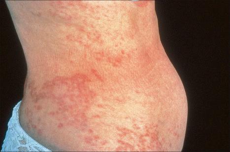 Fig. 9.29, Generalized granuloma annulare: there are widespread papules and plaques.