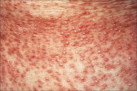 Fig. 9.33, Papular granuloma annulare: numerous small, scaly papules are present.