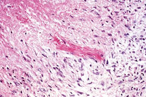 Fig. 9.34, Granuloma annulare: view through the edge of a necrobiotic focus. In the center, a small blood vessel shows fibrinoid necrosis with occlusion. This is an uncommon finding.