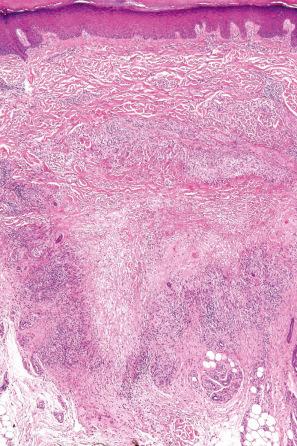 Fig. 9.37, Localized granuloma annulare: this lesion is from the palm of the hand, an uncommonly affected site. There is a sharply delineated focus of necrobiosis in the deep reticular dermis.