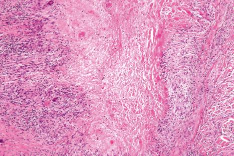 Fig. 9.38, Localized granuloma annulare: the necrobiosis is advanced, presenting as eosinophilic granular debris. The histiocytic palisade is well established.