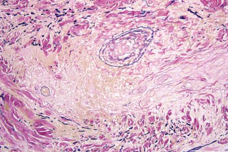 Fig. 9.39, Localized granuloma annulare: there is loss of elastic tissue within the granuloma. Elastic-van Gieson.