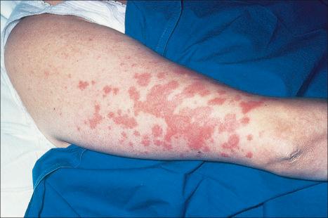 Fig. 9.4, Sarcoidosis: widespread erythematous plaques on the upper arm, some with an annular appearance.