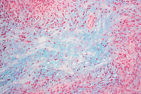 Fig. 9.41, Localized granuloma annulare: in this example, there is abundant mucin in the center of the necrobiotic focus. Alcian blue stain.