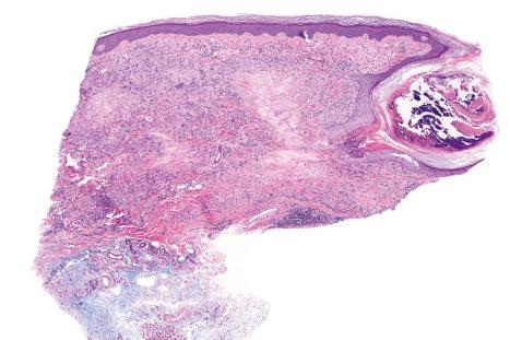 Fig. 9.46, Perforating granuloma annulare: scanning view showing widespread typical granuloma annulare (in the upper-right quadrant, degenerate collagen is undergoing transepidermal elimination).