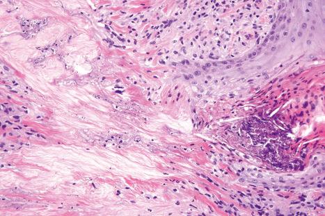 Fig. 9.47, Perforating granuloma annulare: close-up view showing the dermal perforation and transepidermal elimination of collagenous debris.