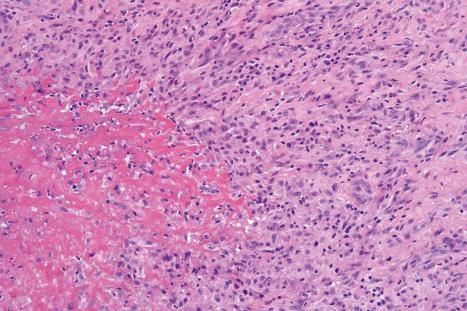 Fig. 9.49, Subcutaneous granuloma annulare: note the intensely eosinophilic necrobiosis and surrounding fibrosis.