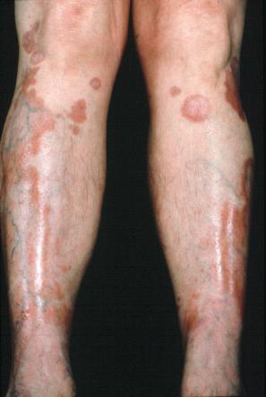 Fig. 9.50, Necrobiosis lipoidica: characteristic, bilateral, symmetrical lesions.