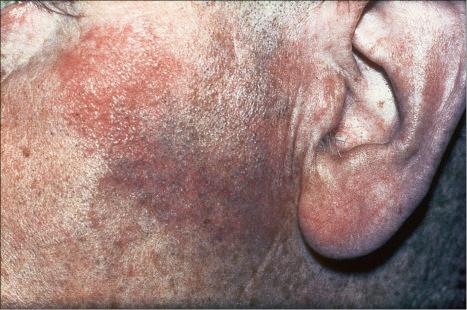 Fig. 9.5, Sarcoidosis: characteristic mauve plaque on the malar area with an infiltrative appearance.