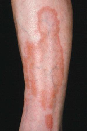 Fig. 9.51, Necrobiosis lipoidica: typical lesion with an erythematous border.