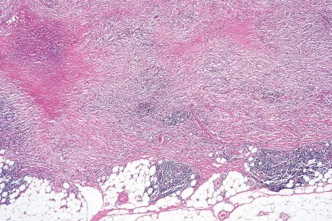 Fig. 9.55, Necrobiosis lipoidica: the lesion extends down to the subcutaneous fat.