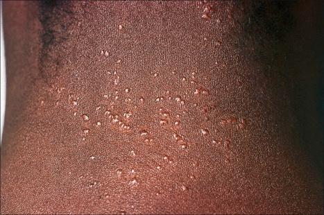 Fig. 9.6, Sarcoidosis: micropapular variant. Note the tiny lichenoid papules.