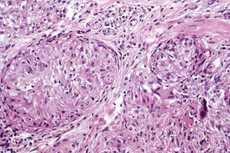 Fig. 9.62, Necrobiosis lipoidica (granulomatous variant): the naked granulomata are very reminiscent of sarcoidosis. Note the multinucleate giant cells.