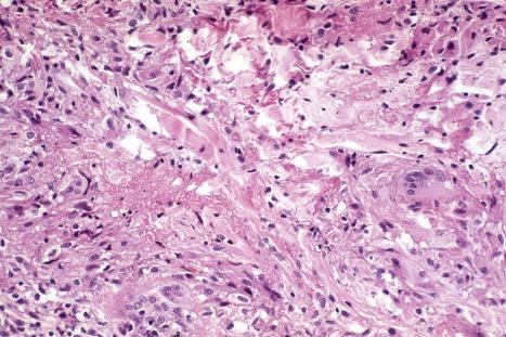 Fig. 9.63, Necrobiosis lipoidica (granulomatous variant): higher-power view of the necrobiotic focus seen in Fig. 9.61 .