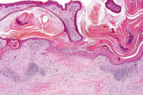 Fig. 9.64, Perforating necrobiosis lipoidica: there is widespread hyperkeratosis and crusting. A perforating channel is seen on the right side of the picture.