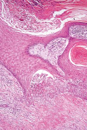 Fig. 9.65, Perforating necrobiosis: close-up view of the perforating channel.