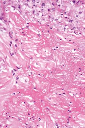 Fig. 9.66, Perforating necrobiosis: the dermis immediately beneath the site of perforation shows severe necrobiotic change.