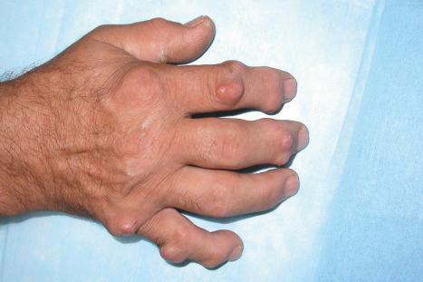 Fig. 9.67, Rheumatoid nodules: lesions on the knuckles are commonly seen in rheumatoid arthritis.