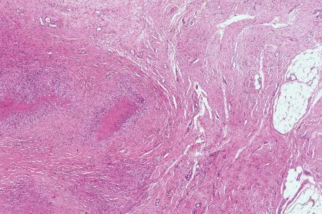 Fig. 9.70, Rheumatoid nodule: in this example, tendon can be seen on the right side of the field.