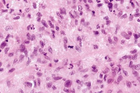 Fig. 9.72, Rheumatoid nodule: the palisading histiocytes may sometimes show mitotic figures which may lead the unwary to consider epithelioid sarcoma.