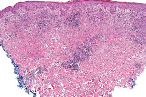 Fig. 9.73, Actinic granuloma: a granulomatous reaction is present the superficial dermis surrounding an ill-defined necrobiotic process. Solar elastosis is evident.