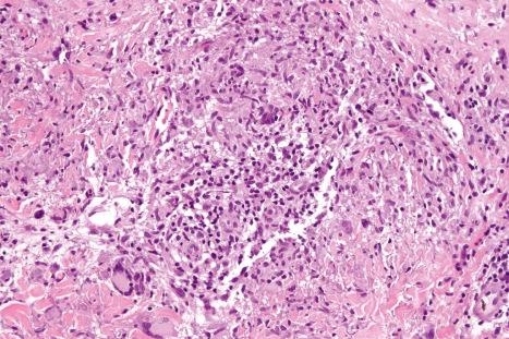 Fig. 9.75, Actinic granuloma: the granulomatous infiltrate is associated with degenerate elastic fibers.