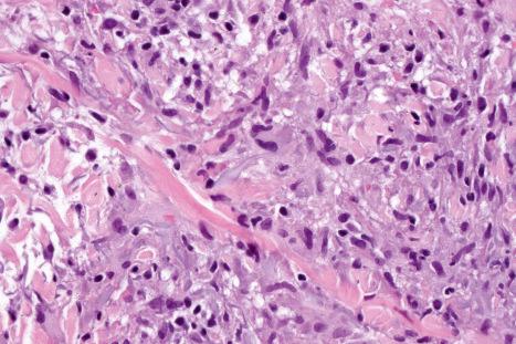 Fig. 9.77, Actinic granuloma: high-power view of basophilic degenerate elastic fibers.