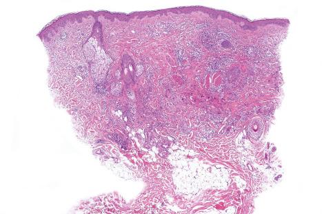 Fig. 9.79, Atypical facial necrobiosis lipoidica: a dense granulomatous infiltrate occupies the dermis.