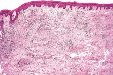 Fig. 9.84, Granuloma multiforme: there is extensive necrobiosis.