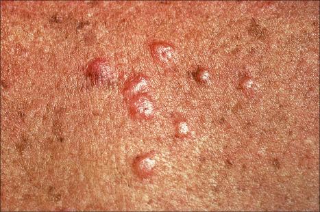 Fig. 9.10, Sarcoidosis: these grouped nodules are present on sun-damaged skin of the upper chest.