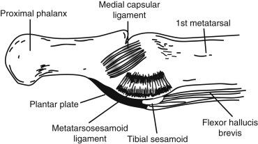 Fig. 21.1, Medial diagrammatic representation of first metatarsophalangeal joint.