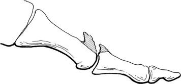 Fig. 21.2, Twenty percent to 30% of the metatarsal head is removed, as well as the exostosis.