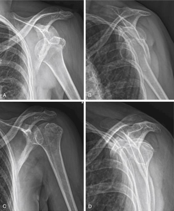 FIG. 29.2, Fracture of the greater tuberosity in the context of a glenohumeral dislocation. After reduction of dislocation, the fracture was reduced to its native position and was treated nonsurgically. (A) Anteroposterior x-ray of left shoulder. An anterior glenohumeral dislocation can be seen. There is a comminuted fracture of the greater tuberosity with a minimal superior displacement. (B) Outlet view x-ray of the same shoulder in which posterior displacement of the greater tuberosity fragment can be seen. (C) Anteroposterior x-ray of the same patient after reduction of the anterior glenohumeral dislocation. Fracture of the greater tuberosity was reduced, and conservative treatment was then decided. (D) Outlet view x-ray of the same shoulder in which posterior displacement of the greater tuberosity is also corrected after reduction.