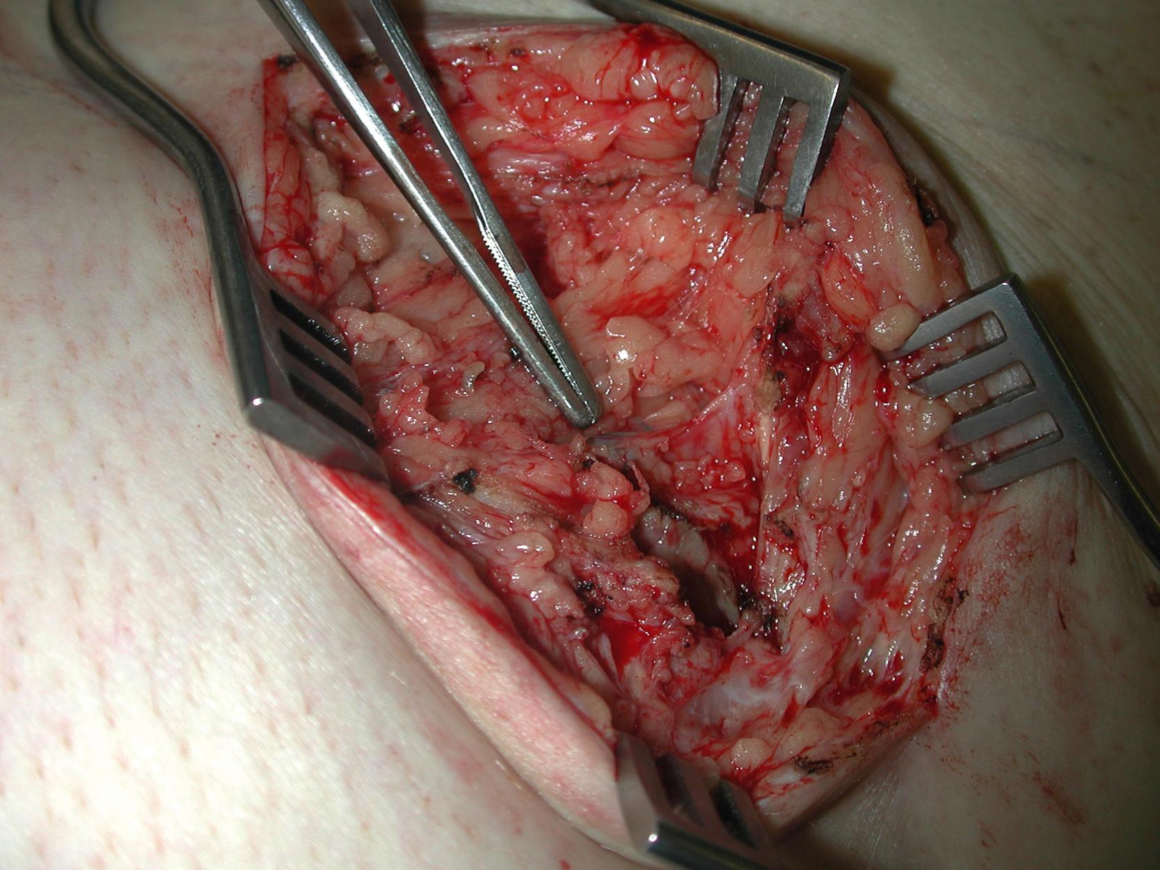 Fig. 32.3, Intraoperative view showing a disrupted, blue-stained lymphatic vessel within the left groin wound (indicated by a forceps ).