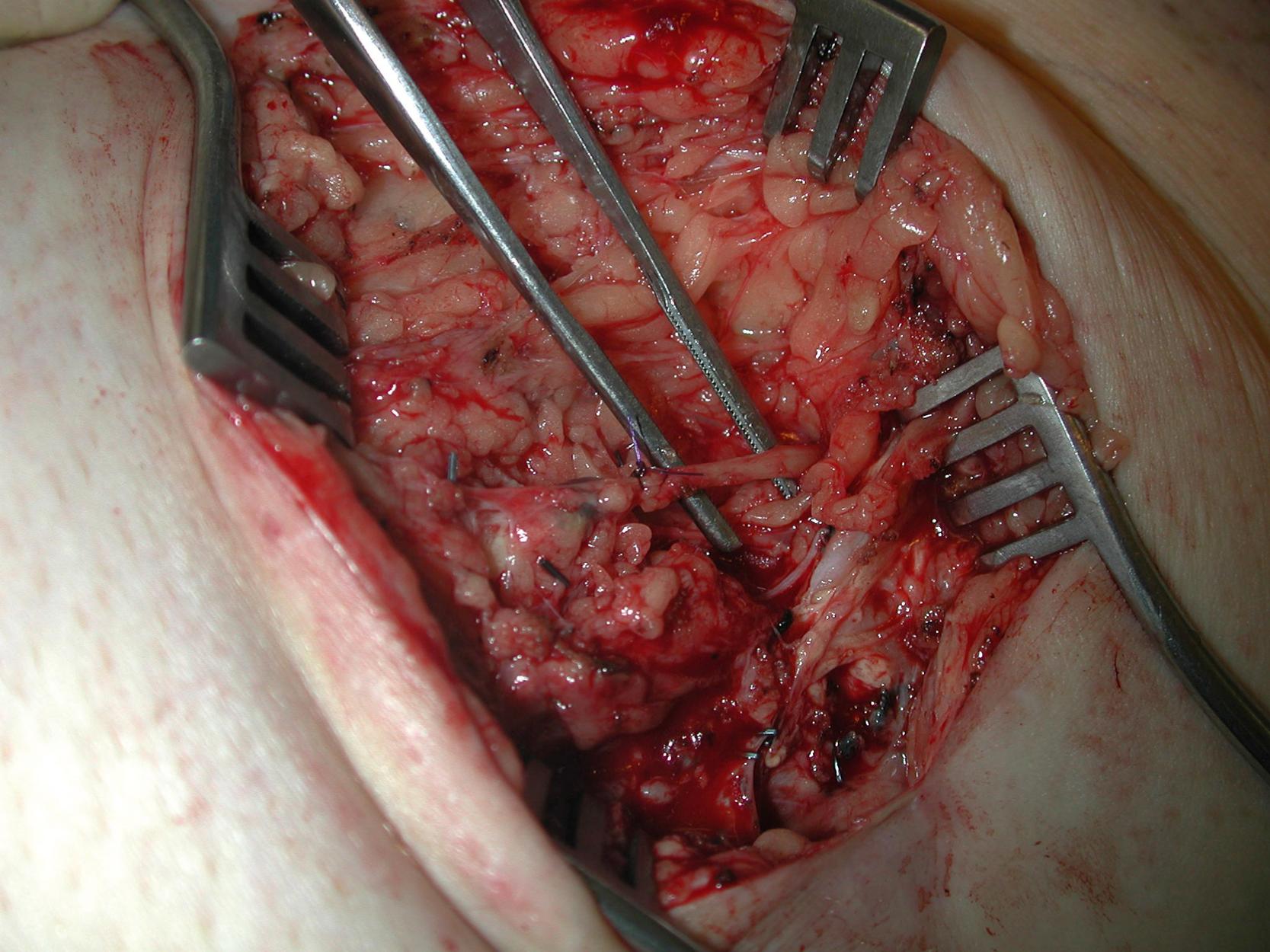 Fig. 32.4, Intraoperative view showing a blue-stained sentinel lymph node and its afferent lymphatic vessel (ligated with a PDS suture) within the left groin wound. Several small lymphatic vessels (occluded with surgical clips) surrounding the lymph node were also noted.