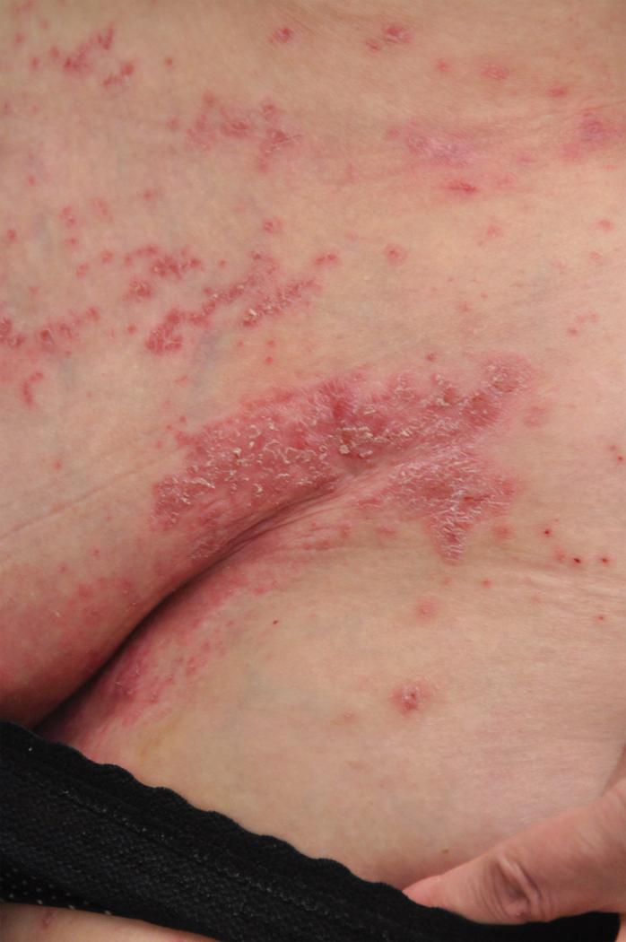 Fig. 5.1, Inverse Psoriasis of the Groin.