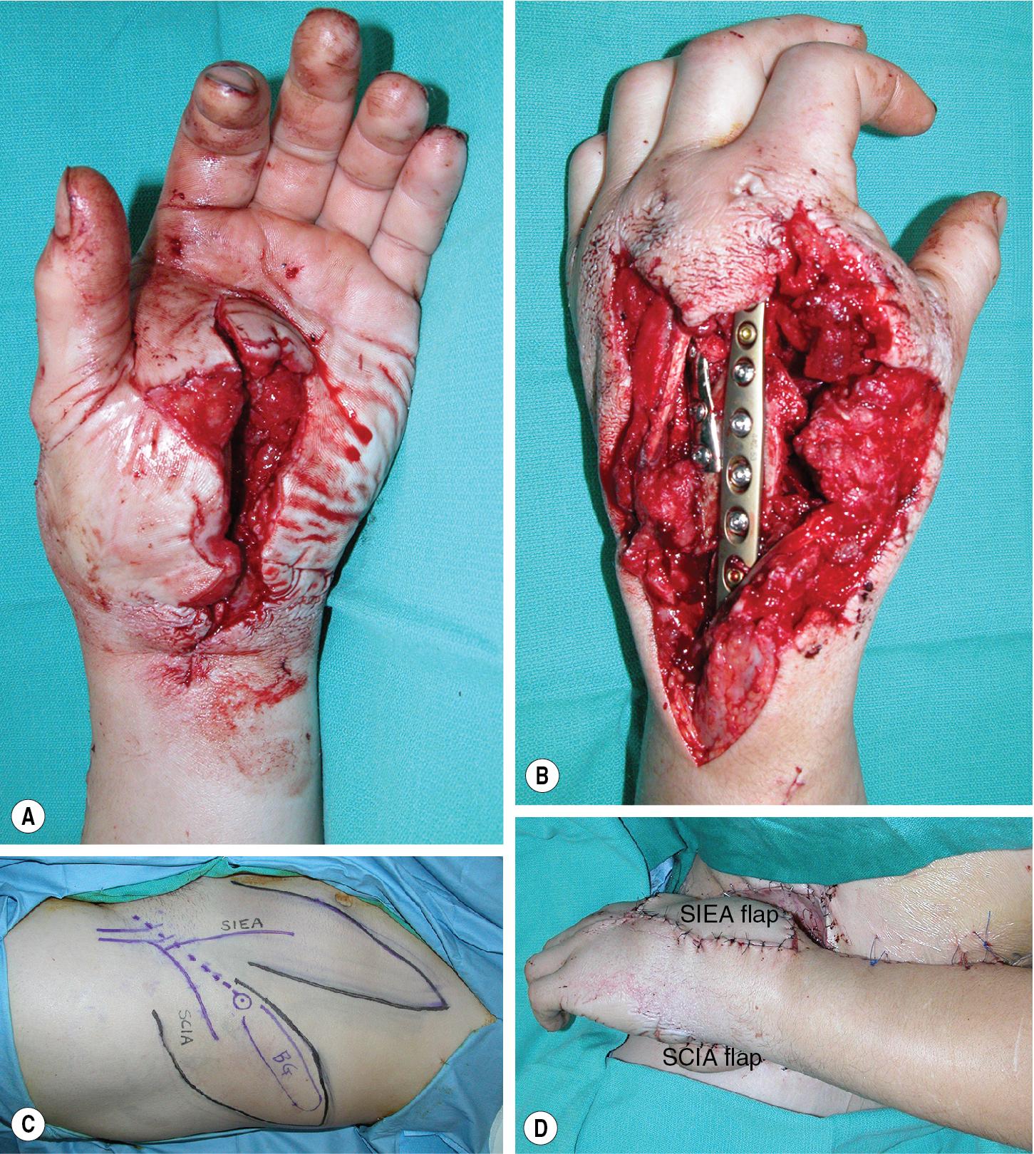 FIGURE 91.1, (A-D) Pedicled groin and abdominal flaps are workhorse flaps for coverage of hand and forearm soft tissue defects.