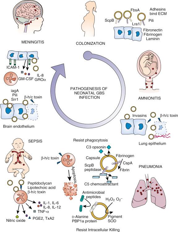 Figure 12-5, Pathologic mechanisms for different types of neonatal group B streptococcal (GBS) infection. ECM, Extracellular matrix; GM-CSF, granulocyte-macrophage colony-stimulating factor; GROα, growth-regulated protein α; β-h/c, β-hemolysin/cytolysin; ICAM-1, intercellular adhesion molecule-1; IL-8, interleukin-8; PBP1a, penicillin-binding protein 1a; PGE2, prostaglandin E2; SOD, superoxide dismutase; TNF-α, tumor necrosis factor-α; TxA2, thromboxane A2.