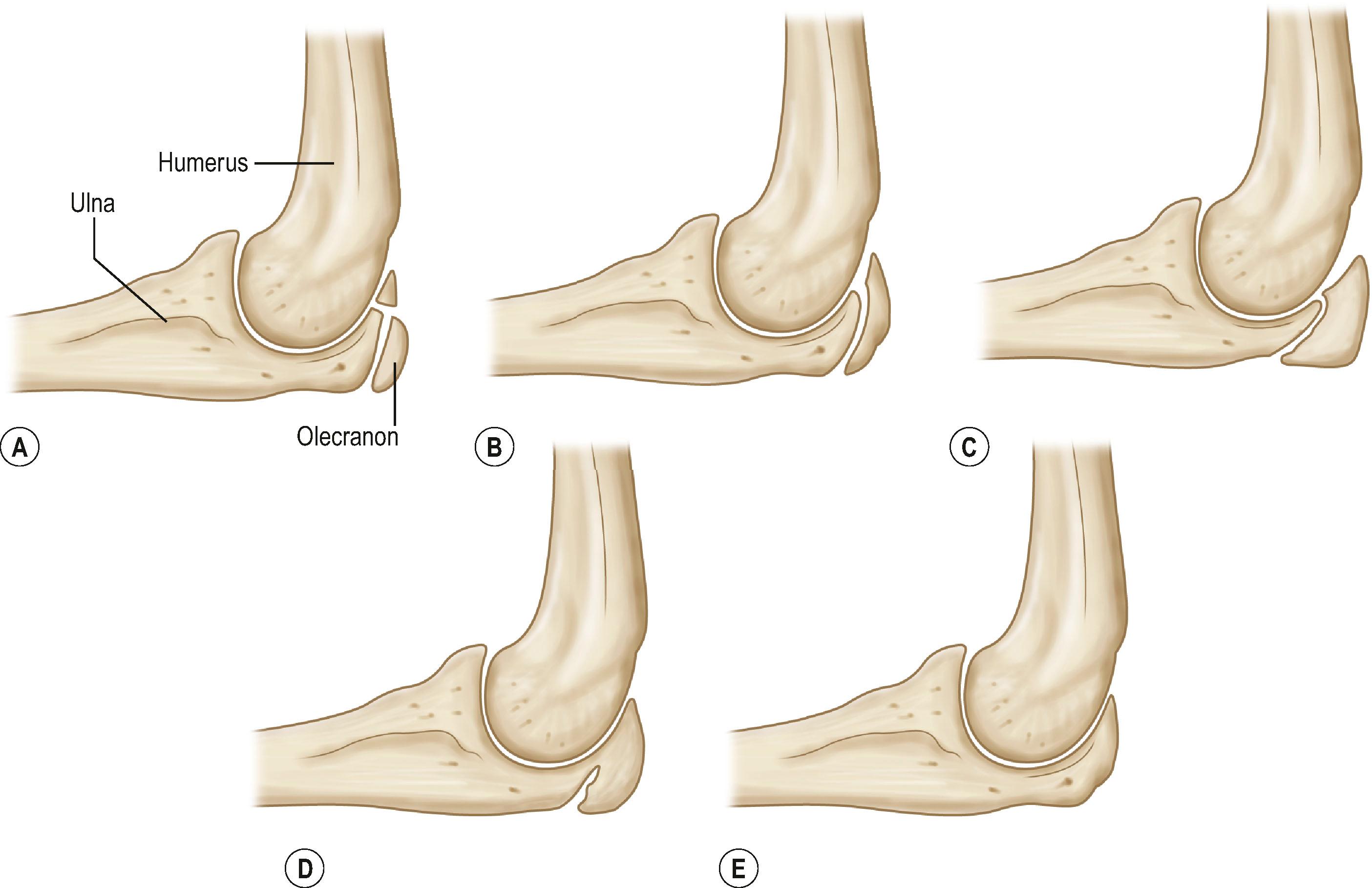 Figure 39.2, Olecranon maturation according to Dimeglio et al ., 35 with significant changes occurring every 6 months. (A) Two ossification centers (girls 11 years; boys 13 years); (B) half-moon shape (girls 11.5 years; boys 13.5 years); (C) rectangular shape (girls 12 years; boys 14 years); (D) beginning of fusion (girls 12.5 years; boys 14.5 years); and (E) complete fusion (girls 13 years; boys 15 years).