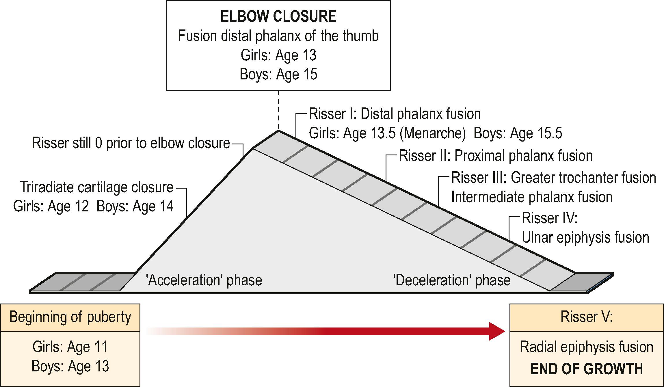 Figure 39.3, Pubertal diagram. Acceleration phase, between skeletal age of 11 and 13 years in girls and 13 and 15 years in boys; Risser sign is 0. End of the acceleration phase, complete elbow and distal phalanx of the thumb closure; Risser sign is still 0.