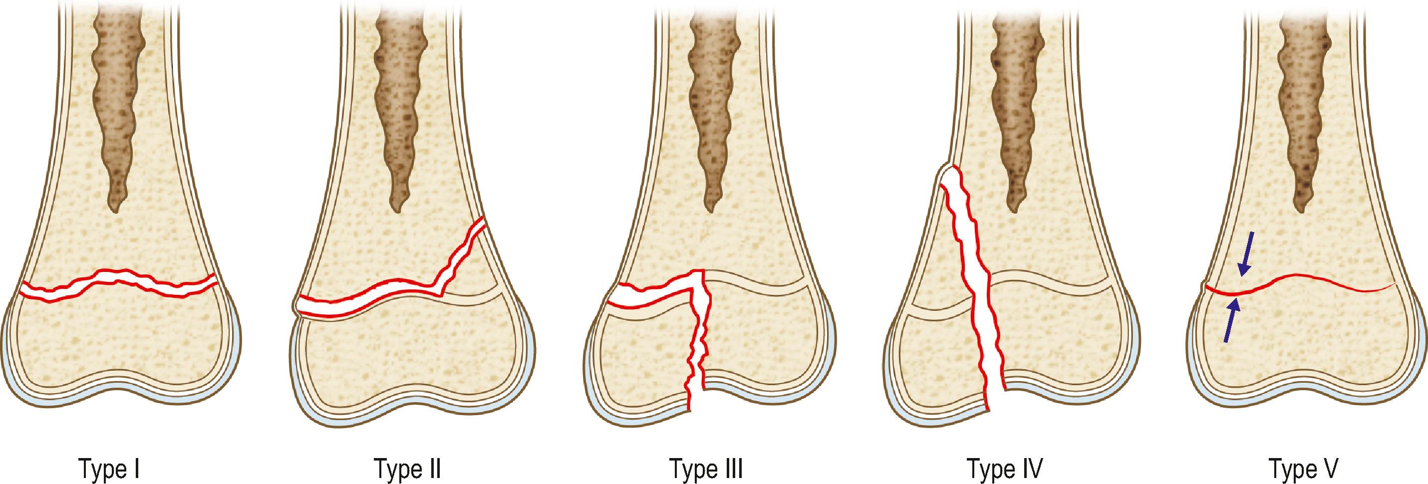 Figure 39.4, Salter–Harris classification of physeal fractures.