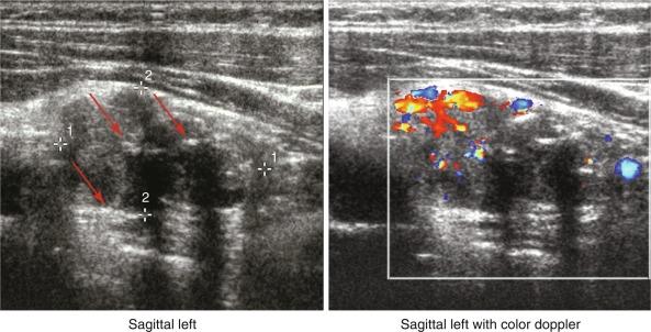 Fig. 54.1, A lower left parathyroid adenoma localized by high-resolution ultrasound. A large (3.2 × 2 × 1.6 cm) lobular hypoechoic mass (outlined by dotted white square) with vascular flow (seen on Doppler imagery) and shadowing calcifications (red arrows) seen in the inferior aspect of the left lobe of the thyroid.