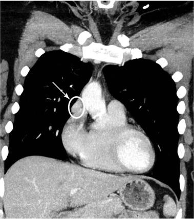 Fig. 54.2, Computed tomography (CT) scan of thorax with intravenous contrast demonstrates a 1.8 × 0.9 cm soft-tissue density adjacent to the right atrium and anterior to the superior vena cava, which corresponds to the area of increased uptake in the mediastinum on 99mTc-sestamibi (MIBI) and combined single-photon emission computed tomography (SPECT)/CT.
