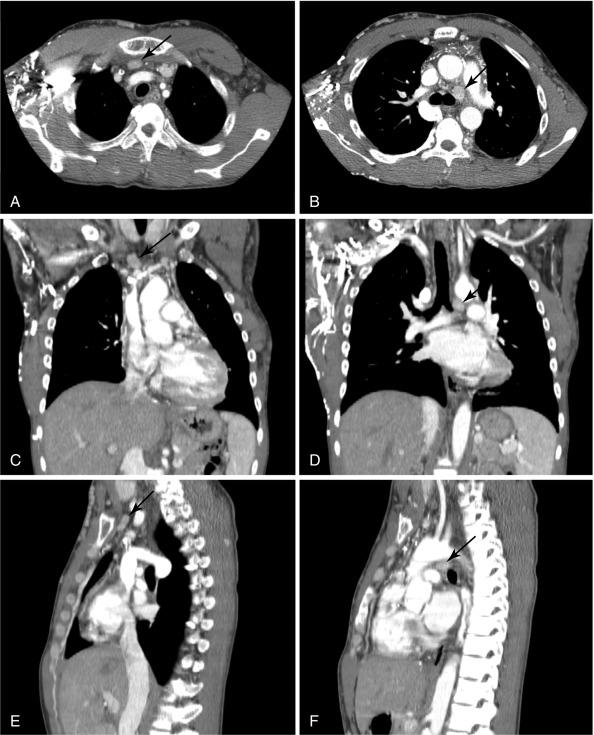 Fig. 54.3, Computed tomography (CT) scan with intravenous contrast in a 29-year-old man with recurrent secondary hyperparathyroidism after a prior subtotal parathyroidectomy. CT scan revealed three ectopic parathyroid glands. They are in the (1) lower left neck below the thyroid but above the clavicle (not shown); (2) upper right anterior mediastinal lesion located behind the sternum and cephalad to the brachiocephalic artery and vein with axial (A) ; coronal (C) ; and sagittal (E) views; (3) deep left mediastinal enhancing mass (1.8 × 1.3 cm) adjacent to the left mainstem bronchus with axial (B) ; coronal (D) ; and sagittal (F) views. The patient had a bilateral neck re-exploration to remove both a left neck and a right anterior mediastinal parathyroid tumor via a cervical incision. The left pulmonary hilum mass was not explored.